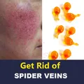 Anti Redness & Spider Vein Removal Advanced Treatment Clearer Skin Veins On Face Facial Varicose