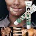 Herbal Extract Vitiligo Ointment Remove Ringworm White Spot Removal Skin Vitiligo Eliminate Vitiligo