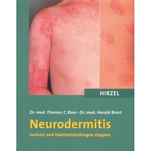 Neurodermitis – Thomas C. Roos, Harald Brost