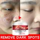 Freckle Whitening Cream Black Dots Melasma Remover Anti Brown Stain Lighten Pigmentation
