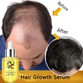 PURC Ginger prodotti per la crescita dei capelli per uomo donna Anti perdita di capelli ricrescita