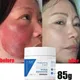 Facial Redness Treatment Cream Instant Rosacea Red Blood Repair Pruducts Anti Redness Spider Vein