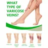 Varicose Vein Relief Gel. Relieve leg bruises