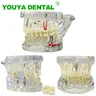 Modello di denti malattia implantare modello di studio del dentista con modelli dimostrativi del