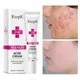 Acne Treatment Blackhead Remova Anti Acne Cream Oil Control Shrink Pores Acne Scar Remove Face