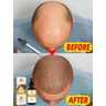 products baldness