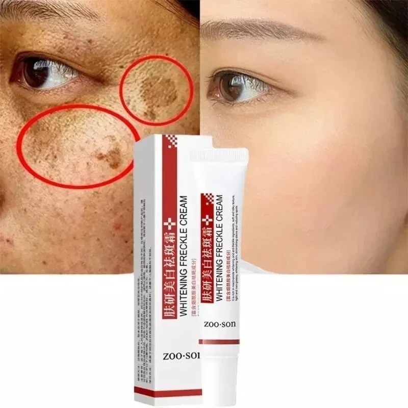 Effective Whitening Freckle Cream Remove Dark Spot Cream Removal Melanin Melasma Effective Whitening Freckle Cream Remove Dark Spot Cream Removal Melanin Melasma