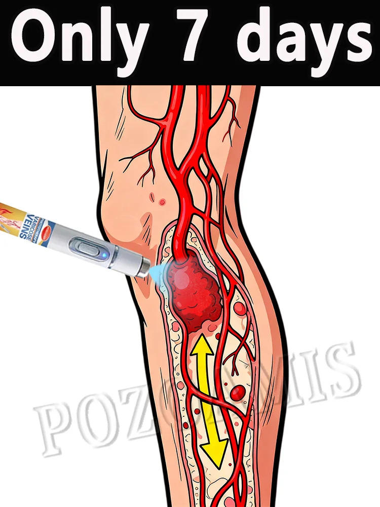 Fördern Sie die Durchblutung in Krampfadern Image